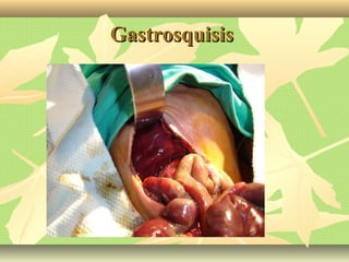 GastrosquisisGastrosquisis
 