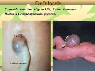 OnfaloceleOnfalocele
Contenido: Intestino, Hígado 35%, Colon, Estomago.
Debido a Cavidad abdominal pequeña.
 