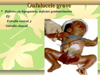 Onfalocele graveOnfalocele grave
 Defectos en hipogastrio, defectos genitourinarios
Ej:
Extrofia vesical, y
extrofia cloacal.
 