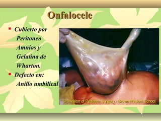 OnfaloceleOnfalocele
 Cubierto por
Peritoneo
Amnios y
Gelatina de
Wharton.
 Defecto en:
Anillo umbilical
 