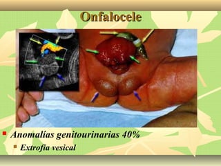 OnfaloceleOnfalocele
 Anomalías genitourinarias 40%
 Extrofia vesical
 