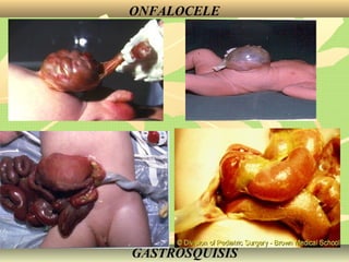 ONFALOCELE
GASTROSQUISIS
 
