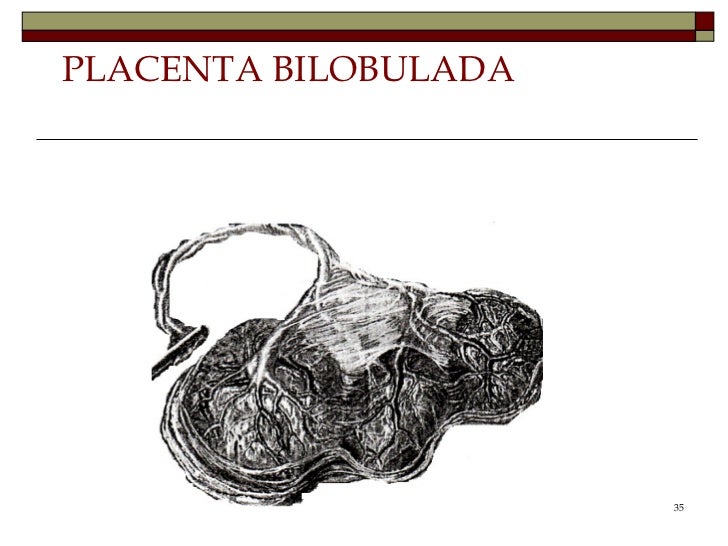 PLACENTA BIPARTIDA