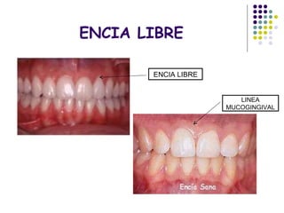 ENCIA LIBRE ENCIA LIBRE LINEA MUCOGINGIVAL 