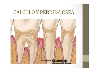 CALCULO	
  Y	
  PERDIDA	
  OSEA	
  
 