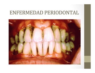 ENFERMEDAD	
  PERIODONTAL	
  
 