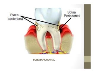 BOLSA	
  PERIODONTAL	
  
Profundización	
  
patológica	
  del	
  
surco	
  gingival	
  
 