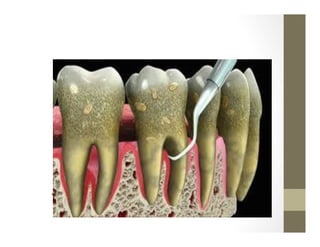TRATAMIENTO	
  PERIODONTAL	
  
 