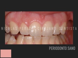 PERIODONTO SANO
N I C O L A S P E R E Z - C I R U J A N O D E N T I S T A
 