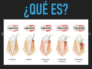 ¿QUÉ ES?
N I C O L A S P E R E Z - C I R U J A N O D E N T I S T A
 