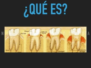 ¿QUÉ ES?
N I C O L A S P E R E Z - C I R U J A N O D E N T I S T A
 