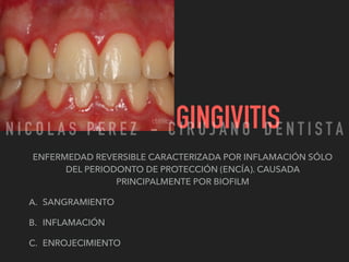 GINGIVITIS
ENFERMEDAD REVERSIBLE CARACTERIZADA POR INFLAMACIÓN SÓLO
DEL PERIODONTO DE PROTECCIÓN (ENCÍA). CAUSADA
PRINCIPALMENTE POR BIOFILM
A. SANGRAMIENTO
B. INFLAMACIÓN
C. ENROJECIMIENTO
N I C O L A S P E R E Z - C I R U J A N O D E N T I S T A
 