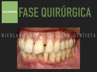 FASE QUIRÚRGICA
FASE QUIRÚRGICA
N I C O L A S P E R E Z - C I R U J A N O D E N T I S T A
 