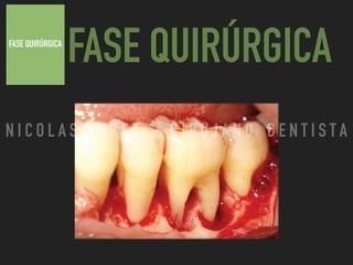 FASE QUIRÚRGICA
FASE QUIRÚRGICA
N I C O L A S P E R E Z - C I R U J A N O D E N T I S T A
 