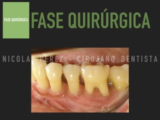 FASE QUIRÚRGICA
FASE QUIRÚRGICA
N I C O L A S P E R E Z - C I R U J A N O D E N T I S T A
 