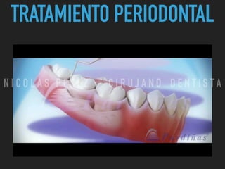 TRATAMIENTO PERIODONTAL
N I C O L A S P E R E Z - C I R U J A N O D E N T I S T A
 