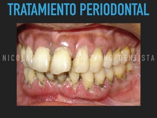 TRATAMIENTO PERIODONTAL
N I C O L A S P E R E Z - C I R U J A N O D E N T I S T A
 