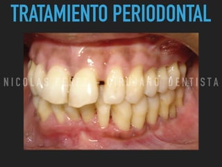 TRATAMIENTO PERIODONTAL
N I C O L A S P E R E Z - C I R U J A N O D E N T I S T A
 