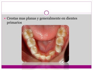  Crestas mas planas y generalmente en dientes
primarios
 
