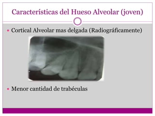 Características del Hueso Alveolar (joven)
 Cortical Alveolar mas delgada (Radiográficamente)
 Menor cantidad de trabéculas
 