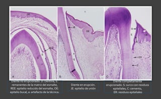 Diente completamente
erupcionado. S: surco con residuos
epiteliales, C: cemento,
ER: residuos epiteliales
Diente en erupción.
JE: epitelio de unión
Diente no erupcionado. D: Dentina, E:
remanentes de la matriz del esmalte,
REE: epitelio reducido del esmalte, OE:
epitelio bucal, a: artefacto de la técnica.
 