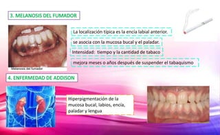 Hiperpigmentación de la
mucosa bucal, labios, encía,
paladar y lengua
La localización típica es la encía labial anterior.
se asocia con la mucosa bucal y el paladar.
Intensidad: tiempo y la cantidad de tabaco
mejora meses o años después de suspender el tabaquismo
 