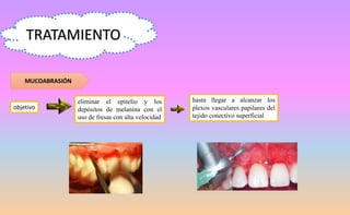 TRATAMIENTO
objetivo
MUCOABRASIÓN
eliminar el epitelio y los
depósitos de melanina con el
uso de fresas con alta velocidad
hasta llegar a alcanzar los
plexos vasculares papilares del
tejido conectivo superficial
 