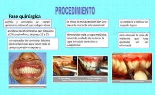 Fase quirúrgica
asepsia y antisepsia del campo
operatorio extraoral con yodopovidona
anestesia local infiltrativa con lidocaína
al 2% y epinefrina, de pieza 15 a 25
un separador de comisuras labiales
plástico bilateral para tener todo el
campo operatorio expuesto
Se inicia la mucoabrasión con una
pieza de mano de alta velocidad
eliminando toda la capa melánica,
teniendo cuidado de no tocar la
capa de tejido conectivo o
subepitelial
se empieza a realizar un
raspado ligero
para eliminar la capa de
melanina que haya
quedado sin ser
eliminada
 