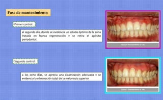 Fase de mantenimiento
Primer control:
al segundo día, donde se evidencia un estado óptimo de la zona
tratada en franca regeneración y se retira el apósito
periodontal.
Segundo control:
a los ocho días, se aprecia una cicatrización adecuada y se
evidencia la eliminación total de la melanosis superior
 