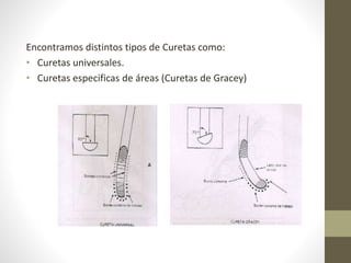 Encontramos distintos tipos de Curetas como:
• Curetas universales.
• Curetas especificas de áreas (Curetas de Gracey)
 