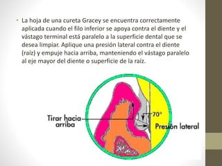 • La hoja de una cureta Gracey se encuentra correctamente
aplicada cuando el filo inferior se apoya contra el diente y el
vástago terminal está paralelo a la superficie dental que se
desea limpiar. Aplique una presión lateral contra el diente
(raíz) y empuje hacia arriba, manteniendo el vástago paralelo
al eje mayor del diente o superficie de la raíz.
 