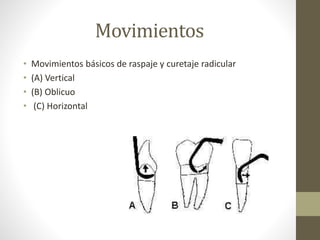 Movimientos
• Movimientos básicos de raspaje y curetaje radicular
• (A) Vertical
• (B) Oblicuo
• (C) Horizontal
 