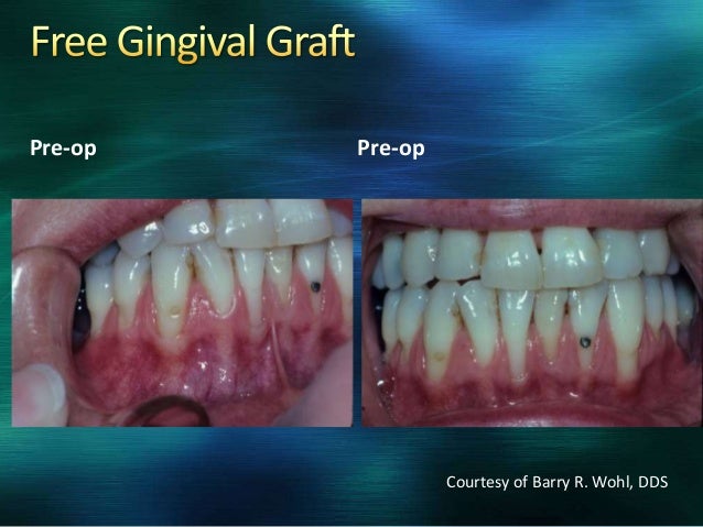 Periodontal Plastic Surgery