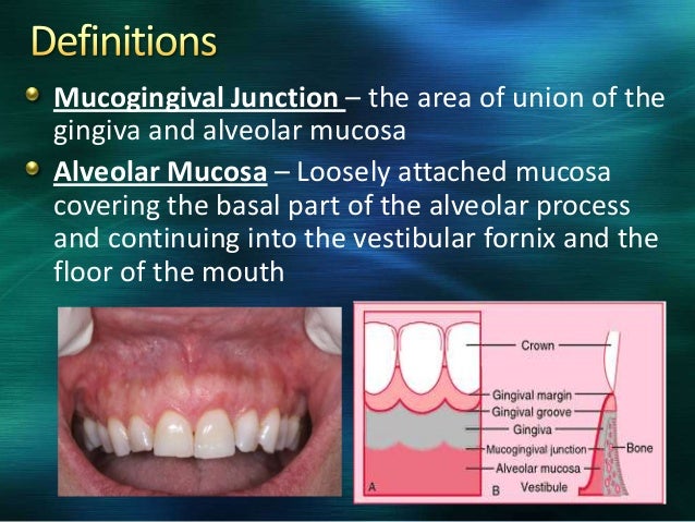 gingival recession