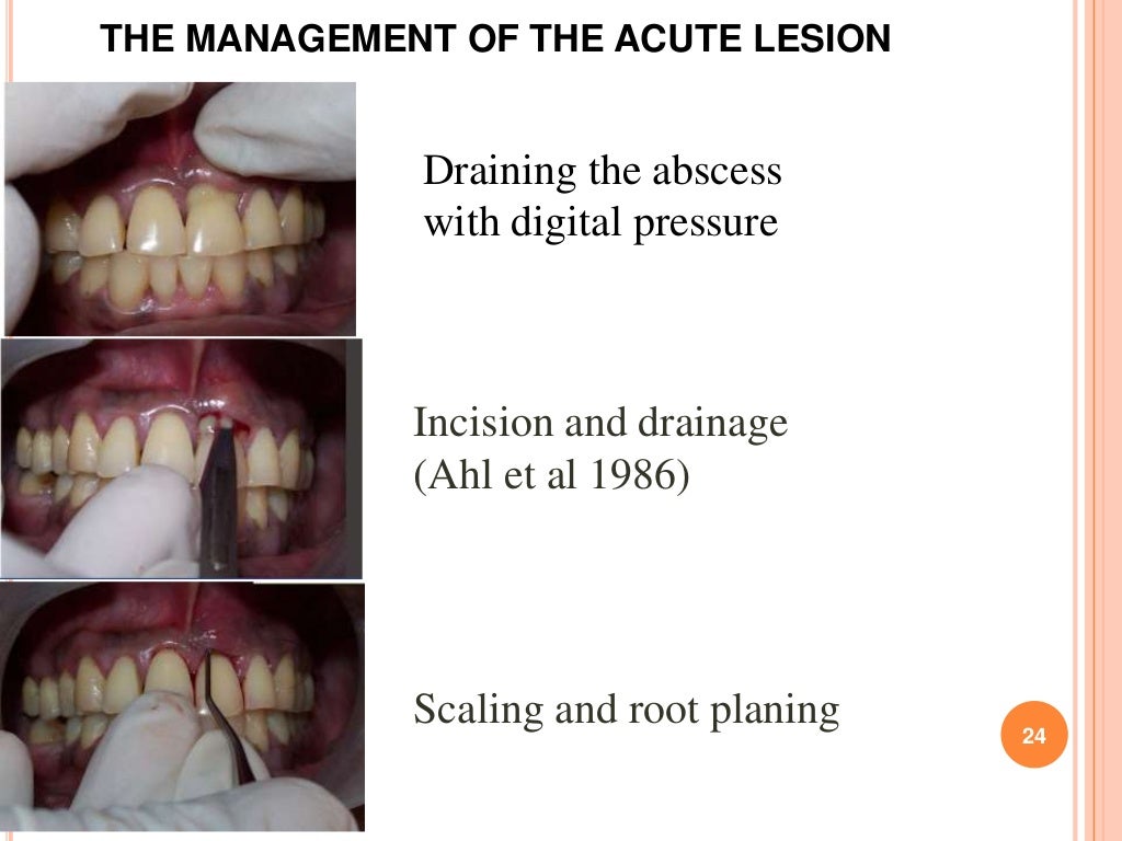 how can i treat a gum abscess at home
