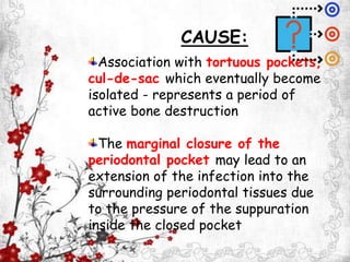 Association with tortuous pockets,
cul-de-sac which eventually become
isolated - represents a period of
active bone destruction
The marginal closure of the
periodontal pocket may lead to an
extension of the infection into the
surrounding periodontal tissues due
to the pressure of the suppuration
inside the closed pocket
CAUSE:
 