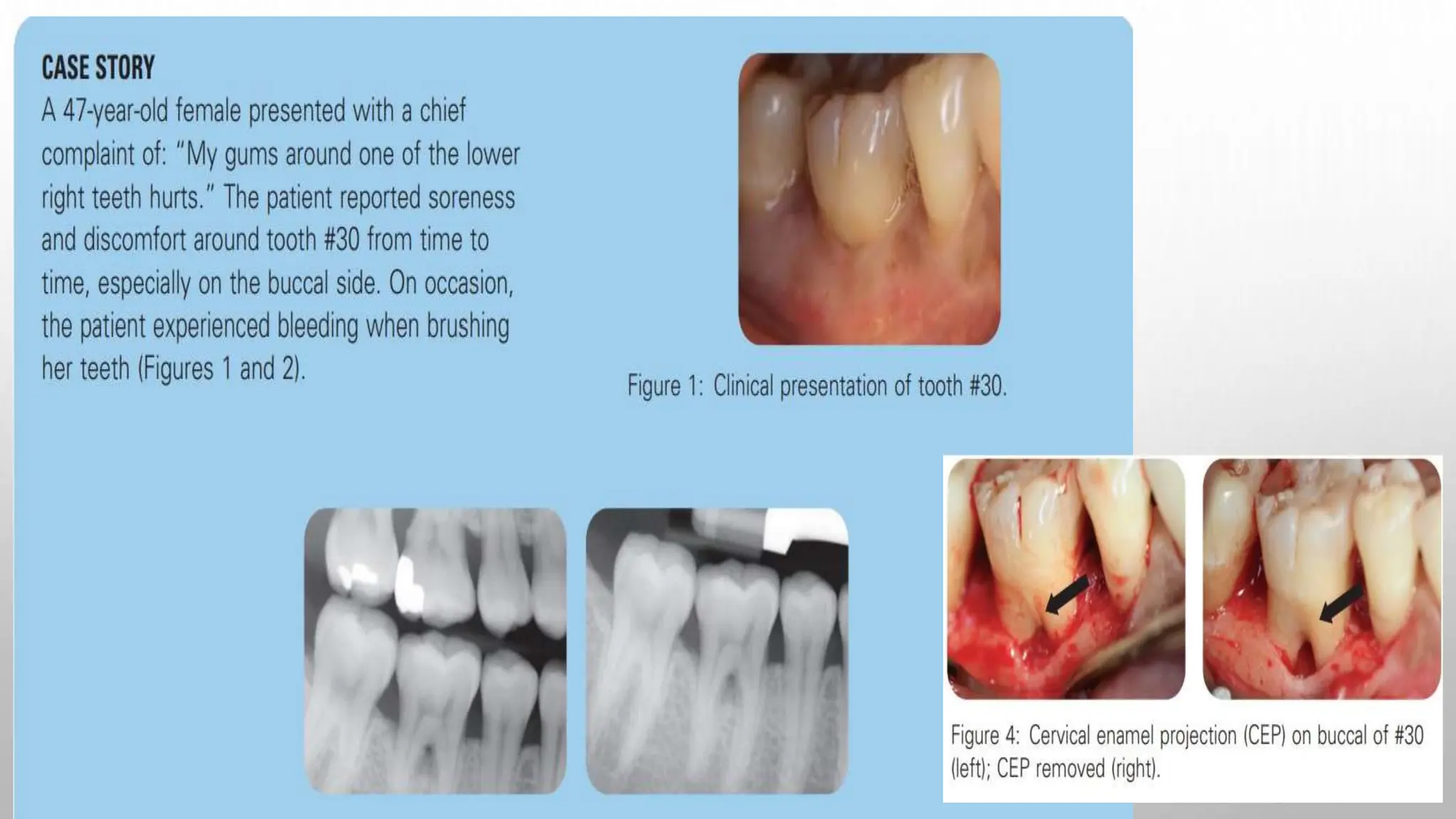 periodontal abscess.pptx