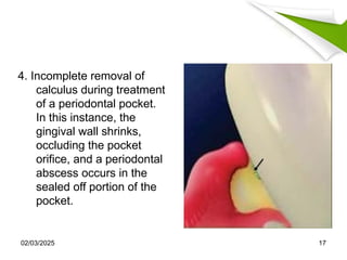 periodontal abscess etiology pathogenesis | PPTX