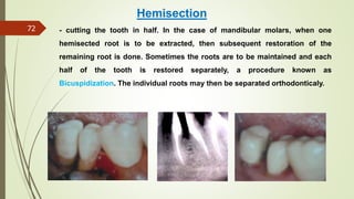 Tooth Hemisection periodontal consideration.pptx