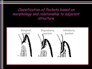 Periodontal Considerations in Fixed Partial Denture | PPT