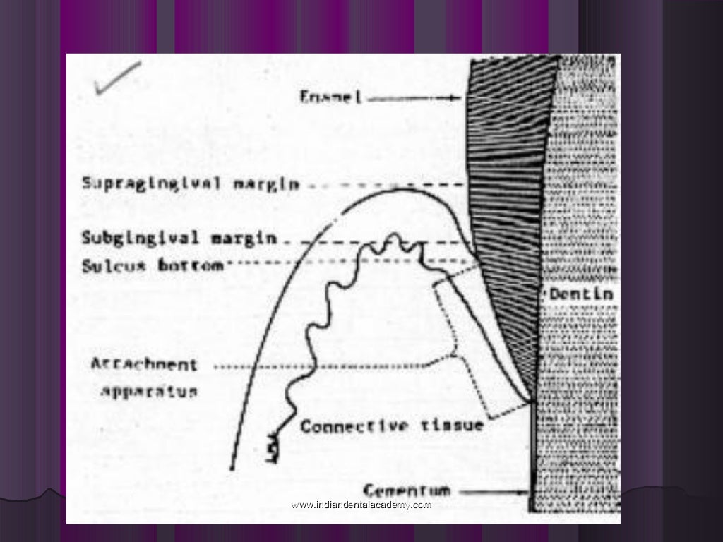 Periodontal considerations in fpd/ orthodontic straight wire technique