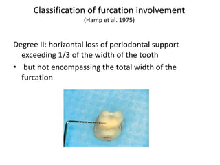Hamp Classification PERIODONTAL DIAGNOSIS AND SCREENING 18.4.19.pdf