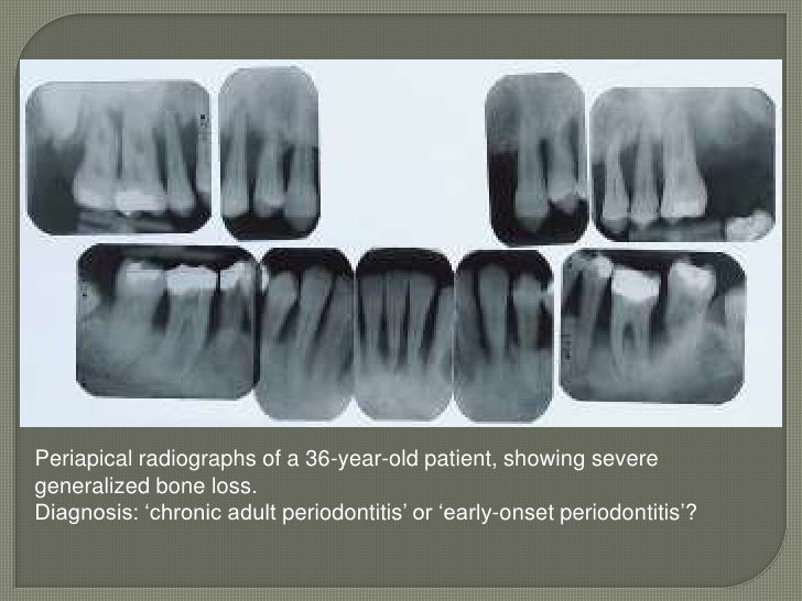 Ada Periodontal Classification Chart