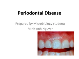 Periodontal Disease Prepared by Microbiology student: Minh Anh Nguyen 