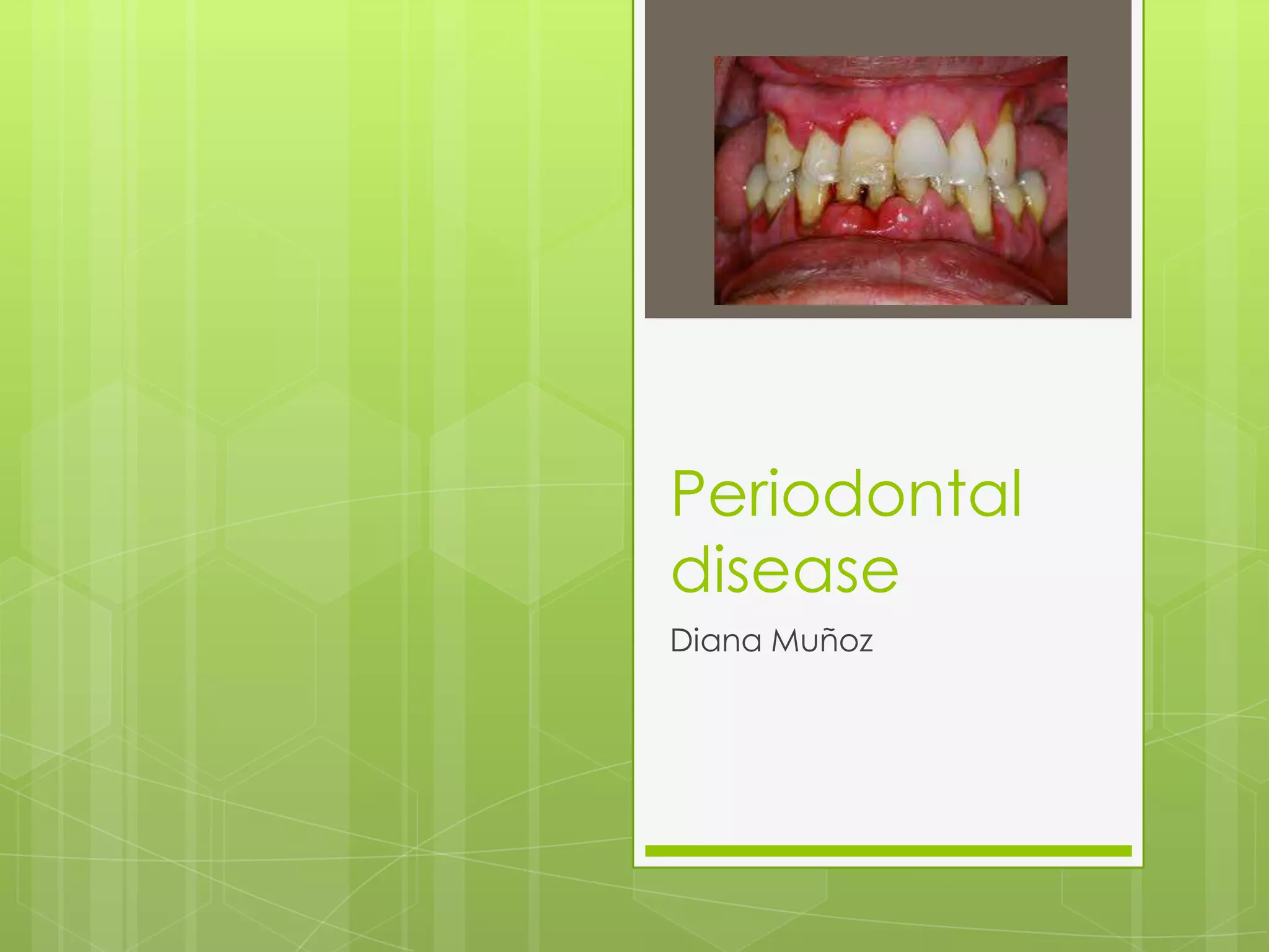 Periodontal disease | PPTX