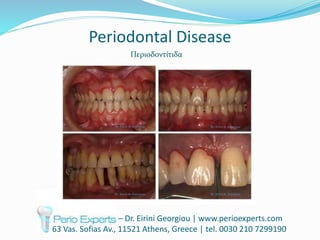 Periodontal Disease
– Dr. Eirini Georgiou | www.perioexperts.com
63 Vas. Sofias Av., 11521 Athens, Greece | tel. 0030 210 7299190
Περιοδοντίτιδα
 