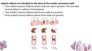 periodontal disease.ppt periodontal pocket | PPTX