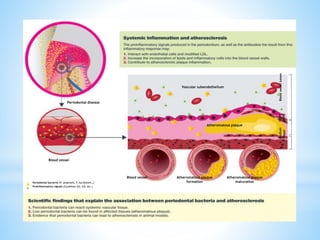 Periodontal disease and cardio vascular disease shree | PPTX
