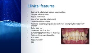 Clinical features
• Supra and subgingival plaque accumulation
• Gingival inflammation
• Pocket formation
• Loss of periodontal attachment
• Occasional suppuration
• Poor oral hygience-gingiva is typically may be slightly to moderately
swollen
• Color-pale red
• Consistency-soft or firm
• Surface topography-loss of stippling
• Flattened or cratered papillae
• Furcation
• Tooth mobility
• BOP
 