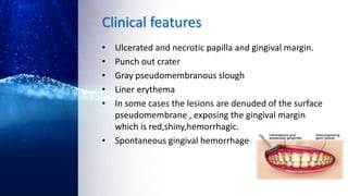 Clinical features
• Ulcerated and necrotic papilla and gingival margin.
• Punch out crater
• Gray pseudomembranous slough
• Liner erythema
• In some cases the lesions are denuded of the surface
pseudomembrane , exposing the gingival margin
which is red,shiny,hemorrhagic.
• Spontaneous gingival hemorrhage
 